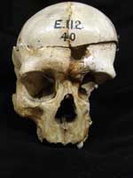 Skull from Rodmarton, Gloucestershire, with a linear fracture caused by a severe blow